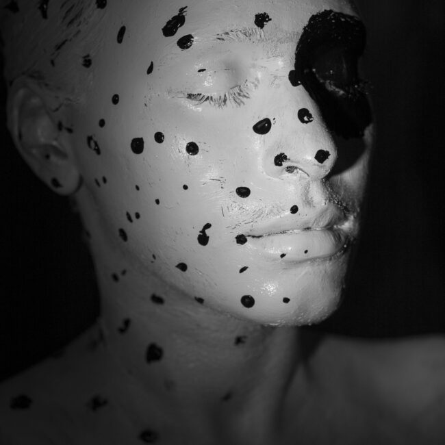 лечение на акне